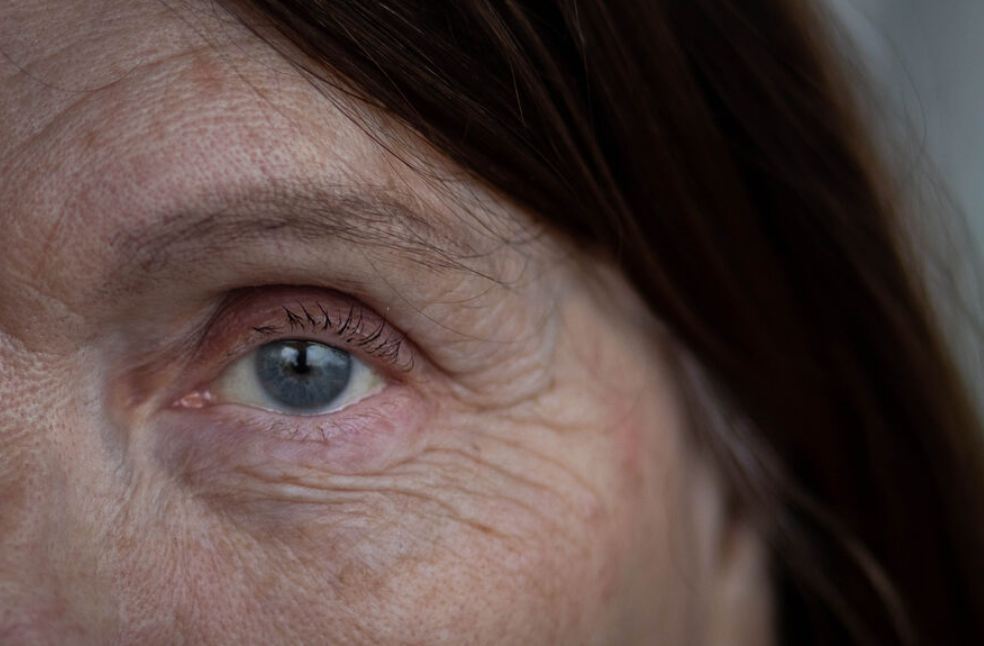 New laser technique could slow vision loss from AMD