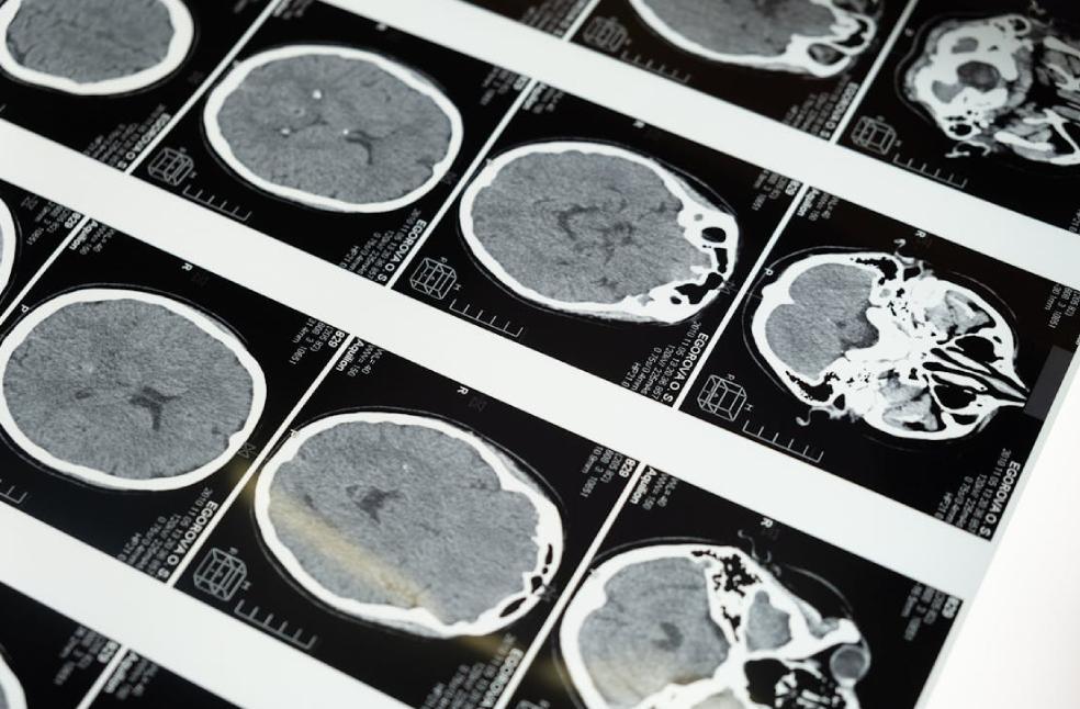 MRI Images of the Brain